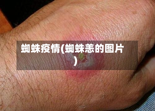 蜘蛛疫情(蜘蛛恙的图片)-第1张图片