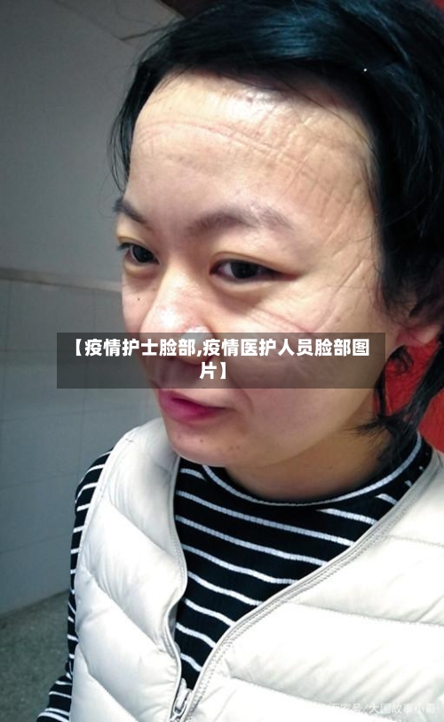 【疫情护士脸部,疫情医护人员脸部图片】-第2张图片